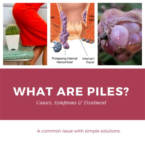 what are piles causes and treatment healthproadvice