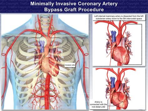 Minimally Invasive Coronary Artery Bypass Graft Procedure