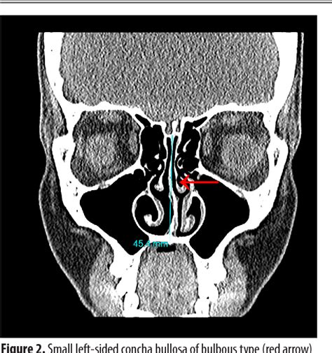 S Shaped Nasal Septum Deviation Ct Pdf Anatomic Variations Of The