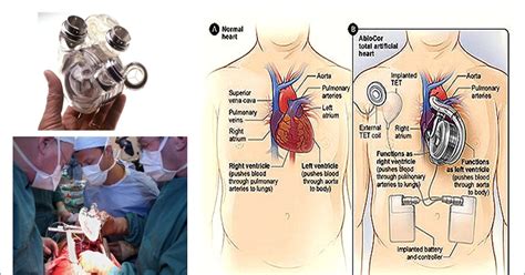 Medical News Artificial Hearts Use Marks Milestone
