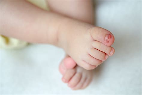 Ingrown nails happen when your nail grows into your skin instead of prescription antibiotics. Baby's Ingrown Toenails: Causes, Treatment, And Prevention