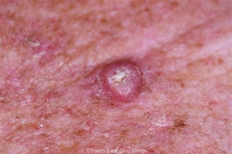 Scc Squamous Cell Carcinoma South East Skin Clinic