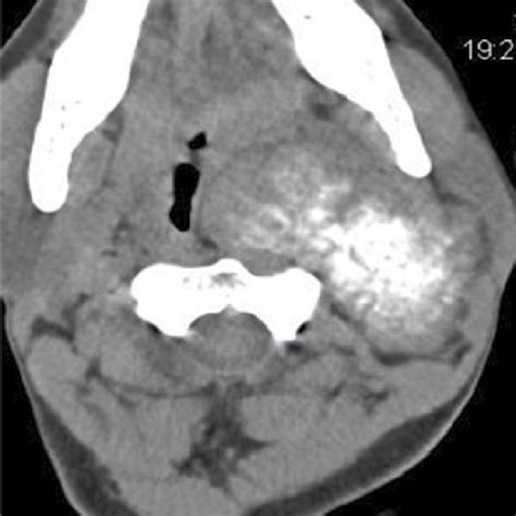 Plain Ct Scan Axial Section Revealed A Well Defined Soft Tissue
