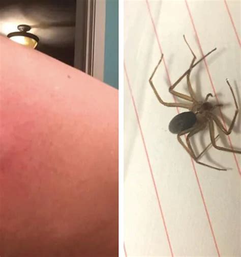 Shocking Photos Of Womans Year Long Recovery From A Spider Bite Nz