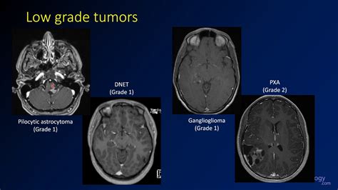Imaging Brain Tumors 4 Other Low Grade Gliomas Youtube