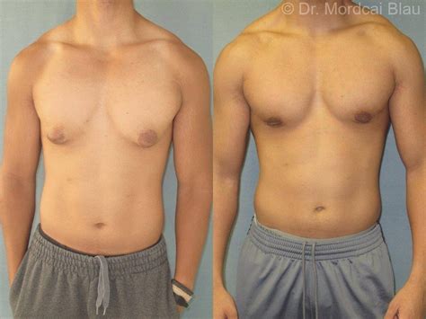 Getting Into Shape With Gynecomastia Before And After Photos