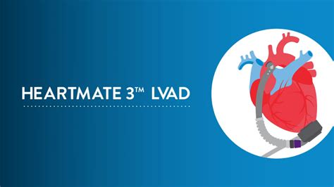 Understanding Heartmate 3 Lvad Therapy Abbott