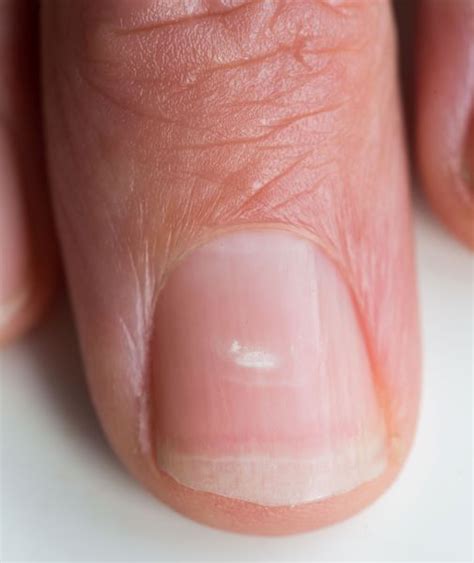 Image White Spot On The Nail Msd Manual Professional Edition