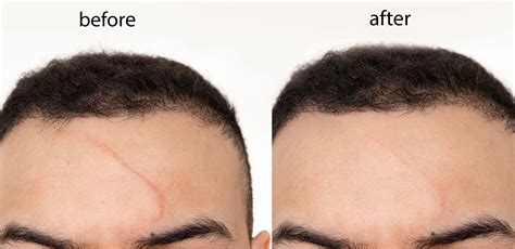 10 Things To Know Before Getting Laser Treatment For Your Scar
