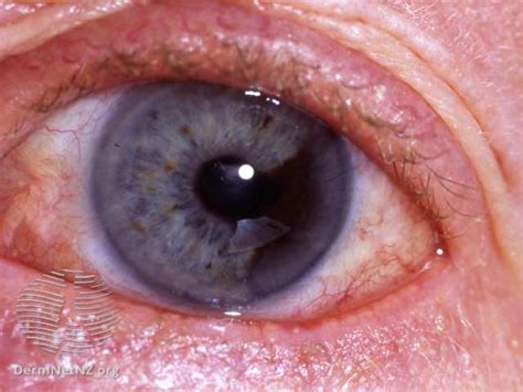 Eye Tumor Types Symptoms Causes Diagnosis