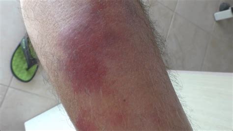 Cellulitis On A Patients Shin Before And 4 Days After Treatment Youtube