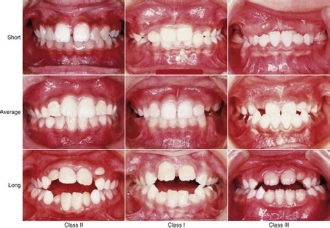 Class Iii Malocclusion Definition He Blogosphere Lightbox