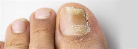A white spot on the cuticle or the hard part of the nail is very common especially in children. How To Make Your Feet Look Healthier
