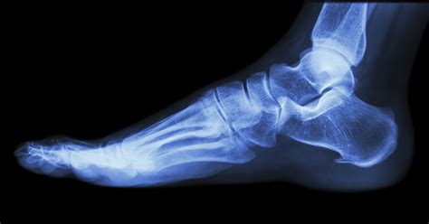 Information About Burning Feet Syndrome Livestrongcom