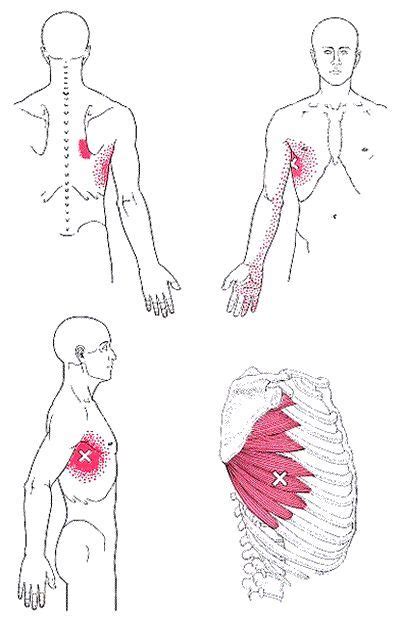 what you need to know about muscle knots or trigger points hand therapy physical therapy