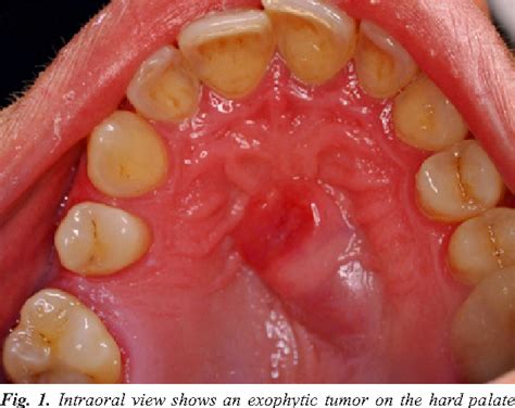 Figure 1 From Ancient Schwannoma Of The Hard Palate An Uncommon Case