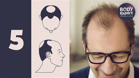 Norwood Hamilton Scale The Stages Of Male Pattern Baldness