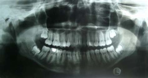 A Calcified Mass Above The Maxillary Canine And Premolars Arrow
