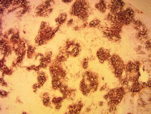 Intensive chemo using several drugs is. Angioimmunoblastic T-cell lymphoma | DermNet NZ