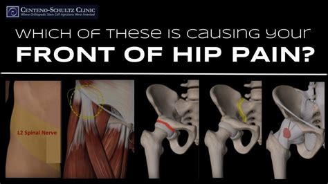 5 Possible Causes For Pain At The Front Of The Hip Stem Cell Blog