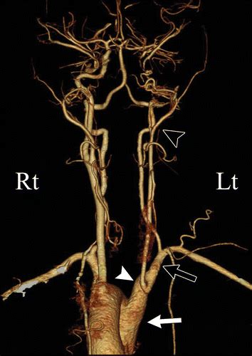 Ct Angiography Of Agenesis Of The Left Internal Carotid Artery Radiology