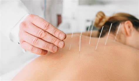 Chinese Acupuncture Stock Photos Pictures And Royalty Free Images Istock