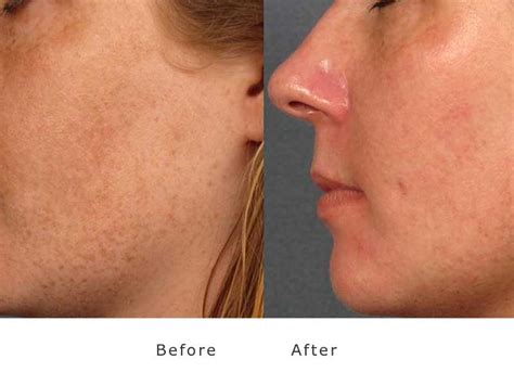 Rosacea And Acne Treatment At My Face Aesthetics Laser Clinic Bolton