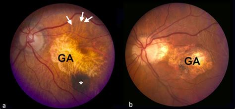 Figure 7 Color Fundus Photograph From Two Webvision Ncbi