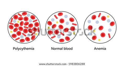 Normal Blood Polycythemia Specimen Anemia Disease Vetor Stock Livre