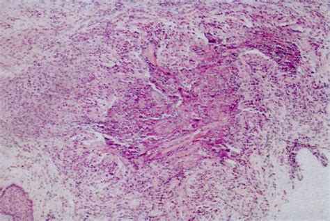 References In Cutaneous Manifestations Of Churg Strauss Syndrome A