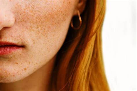 What Is The Difference Between Sunspots And Freckles Elements Magazine