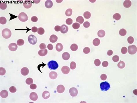 Histopathology Images Of Autoimmune Hemolytic Anemia By