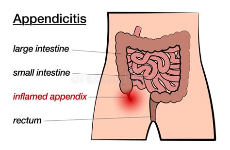 Appendix Colon And Rectum Stock Illustration Illustration Of Intestine 55917625