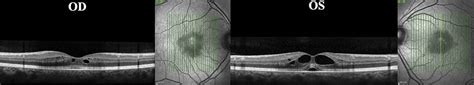 Siponimod Related Bilateral Macular Edema A Transient And C