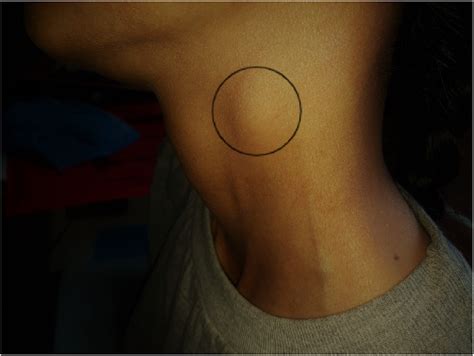 Lateral Neck Swelling Legend Circle Showing Enlarged Cervical Lymph