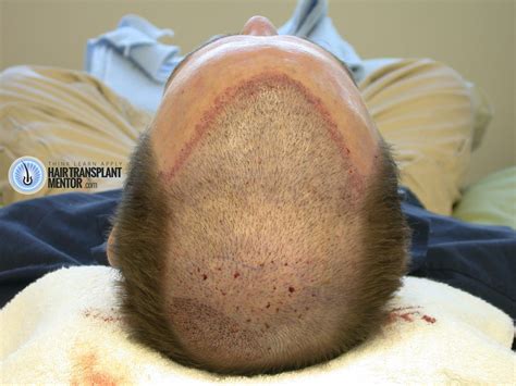 Looking For Hair Transplant Repair Results