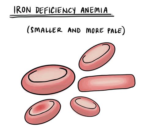 Iron Deficiency Anemia Mypathologyreportca