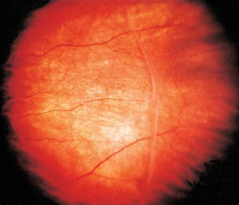 Heredofamilial Vitreoretinopathies Retina And Vitreous Albert
