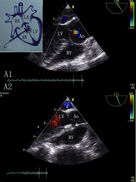 Perventricular Device Closure Of Ventricular Defects In 235 Young