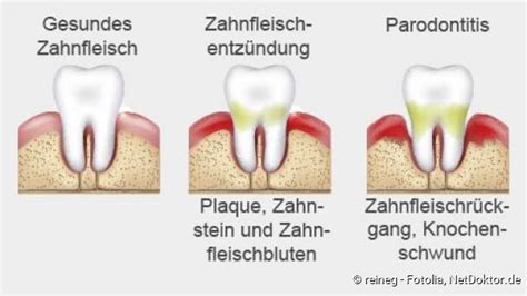 Zahnfleischentz Ndung Gingivitis Ursachen Symptome Behandlung