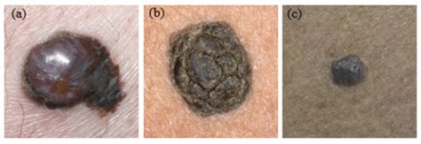 Three Examples Of Pigmented Skin Lesions A Melanoma B Seborrheic