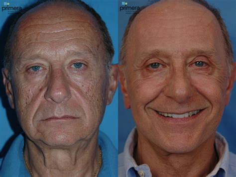 Laser Skin Resurfacing Dot Co2 Before And After Pictures Case 24