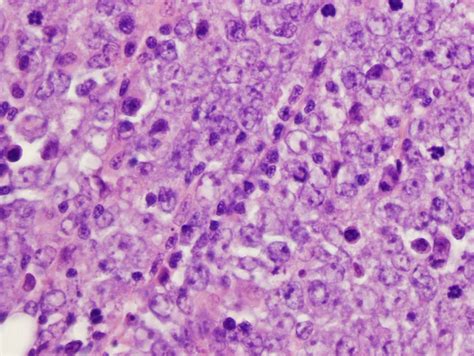 Cureus Tumors Of Atypical Carcinoma Of The Parotid Gland And
