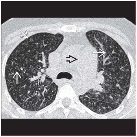 Pulmonary Venoocclusive Disease Radiology Key