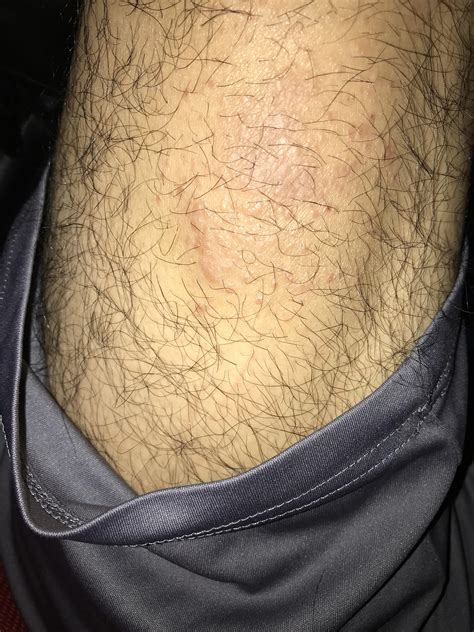 Pimples On Back Of My Leg Popping