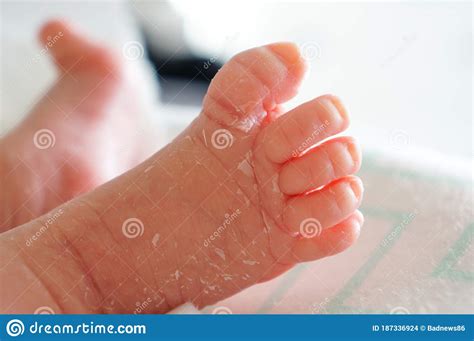 Legs Of A Newborn Peeling Skin Stock Photo Image Of Little Life