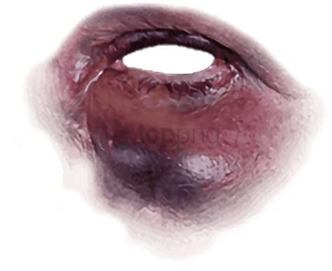 Bruise Png Hd Transparent Png