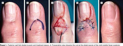 Pdf Skin Excision And Osteophyte Removal Is Not Required In The
