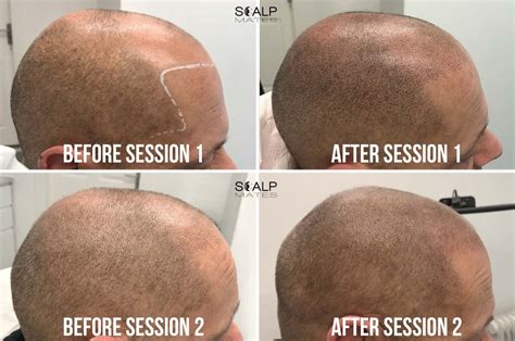 Realistic Hairline Tattoo Scalp Micropigmentation Smp For Short