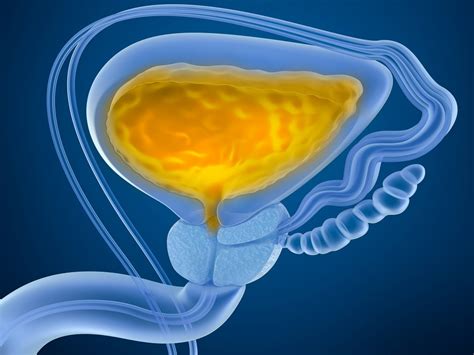 Bladder Cancer Recurrence Risk Lower In Metformin Users Renal And